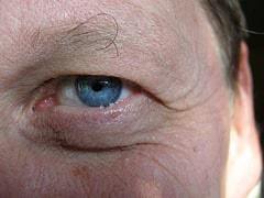 eye with wrinkled skin