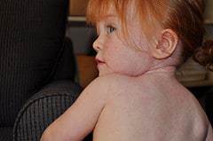 redheaded child with spots